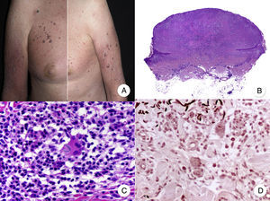 A, Photograph showing a patient with atrophic plaques and atrophic nodules with a parchment-like surface. B, Panoramic view of a diffuse infiltrate occupying the entire dermis. C, Detailed view at a higher magnification of the infiltrate, showing atypical lymphocytes and elastophagocytosis. D, Orcein stain showing the absence of elastic fibers in the dermis.