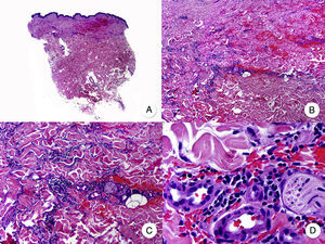 Interstitial mycosis fungoides. A, Panoramic view showing a mild infiltrate in the papillary dermis. B, Higher-magnification view showing the interstitial pattern of the infiltrate. C, D, Detailed view of the predominantly lymphocytic infiltrate among the collagen bundles and other adnexal structures of the dermis.