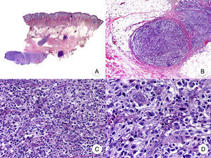 Mycosis fungoides with large-cell transformation. A, Panoramic view of biopsy specimen from the scalp showing the patch-like infiltration of the dermis. B, Detailed view of the neoplastic infiltrate in the hypodermis. C,D, Higher-magnification view showing the large pleomorphic and anaplastic neoplastic cells in the infiltrate.