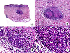 Syringotropic mycosis fungoides. A, Panoramic view showing band-like infiltrate in the reticular and periglandular dermis. B, Higher-magnification view showing dense infiltration of eccrine glands by lymphocytes. C, D, Higher-magnification view showing atypical lymphocytes surrounding an eccrine sweat gland with syringometaplasia.