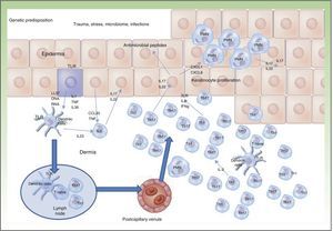 Pathogenic model in psoriasis.