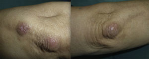 Brownish erythematous plaques on both elbows.