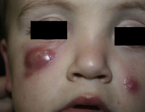 Asymptomatic erythematous-violaceous nodular lesions in the lower right eyelid and in the left cheek.