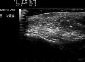 Ultrasound study of the nodule in the left cheek showing a well-defined oval hypoechoic dermal lesion containing no calcium deposits.