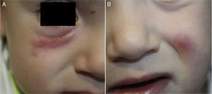 Spontaneous course of the lesions after 4 months. A, Right lower eyelid. B, Left cheek.