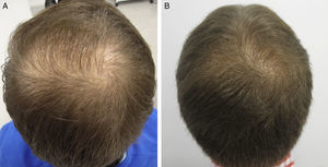 A 26-year-old man with androgenetic alopecia at the vertex. Improvement after treatment with injections of dutasteride in monotherapy every 3 months. A, At baseline. B, After a year of treatment.