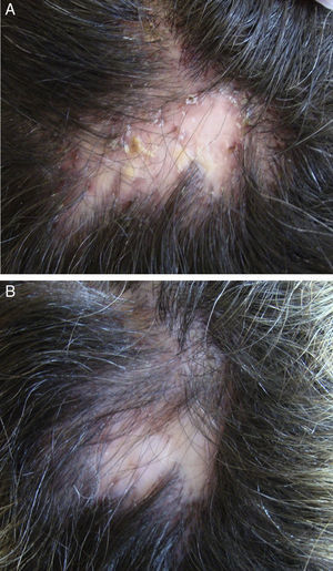 A 33-year-old woman with folliculitis decalvans. Clinical improvement after 10 weeks of treatment with rifampicin, 300mg every 12hours, plus clindamycin, 300mg every 12hours. A, At baseline. B, At the end of treatment.