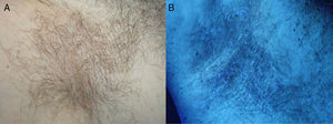 A, Yellowish-white structures adherent to axillary hairs. B, Wood light examination: weak yellow-white fluorescence.