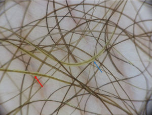 Dermoscopy revealing irregular masses around the hair. The feather sign (red arrow) and the brush sign (blue arrow) are visible.