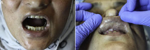 (A) Clinical picture showing maximum opening of the mouth achieved by the patient. (B) Sclerotic appearance of the labial mucosa with blanching and reticular grayish pigmentation.