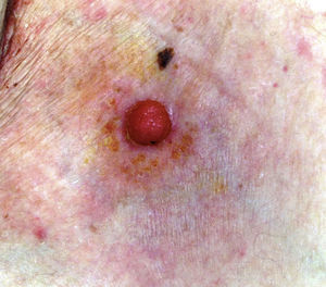 Clinical image of an eccrine porocarcinoma in a patient in the series: a pink papule less than 2cm in diameter. This is the most common form of presentation of this neoplasm.