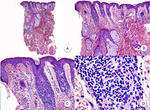 Biopsy of facial papule. A and B, At low magnification, several vellus follicles can be observed with numerous sebaceous glands (hematoxylin-eosin [H-E] ×10, H-E ×100, respectively). C and D, Detail of the inflammatory infiltrate surrounding the upper portion of the vellus follicles (H-E ×200, HE ×400, respectively).