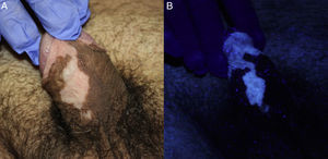 A, Achromic macules on the shaft of the penis and foreskin. B, More evident loss of pigmentation under Wood's light.
