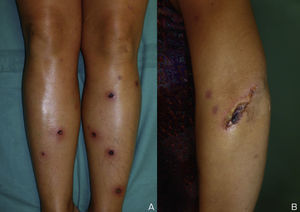 (A) Ulcerated necrotic lesions on both lower legs. (B) Linear ulcer on the left arm exhibiting the pathergy phenomenon.