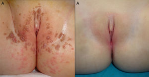 (A) Multiple vestibular and vulvar condyloma acuminata. (B) 13-month follow-up post-CO2 laser surgery of anogenital condyloma acuminata.