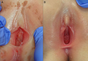 (A) Giant periurethral condyloma acuminata. (B) 13-month follow-up post-CO2 laser surgery for the giant periurethral condyloma acuminata.