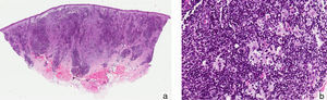 A, Granulomatous lymphohistiocytic infiltrate in the dermis (hematoxylin-eosin, original magnification ×10). B, Higher magnification shows an infiltrate composed of large histiocytes with vesicular nuclei, accompanied by abundant plasma cells and lymphocytes (hematoxylin-eosin, original magnification ×20).