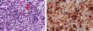 A, Large histiocyte (large arrow) with lymphocytes in its cytoplasm (emperipolesis) (small arrow) (hematoxylin-eosin, original magnification ×40). B, Negative image of inflammatory cells compared to histiocytic cells with immunohistochemical staining for S-100 protein.