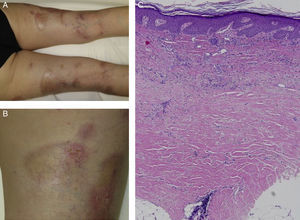 Clinical and histologic images of the patient. A, Hard, pearly plaques with violaceous edges (lilac ring) underneath older psoriasis plaques on the lower limbs. B, More detailed image showing the coexistence of morpheaform plaques and erythematous plaques with a psoriasiform appearance. C, Densely packed collagen bands in the deep reticular dermis, parallel to the dermoepidermal junction (hematoxylin-eosin, original magnification×10).
