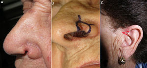 A, Recurrence of the basal cell carcinoma. Photograph taken preoperatively in outpatients. B, First stage of Mohs micrographic surgery. C, Design of the graft at the base of the helix.