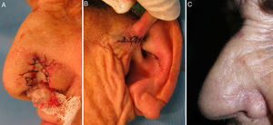 A and B, Postoperative appearance. C, Ten weeks after surgery.