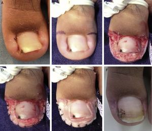 Patient 2. A, Stage 2 disease affecting the left great toe. B, Design of the super U incision. C, Surgical defect left by the super U procedure. D, Hemostatic sutures along the free skin border. E, Application of hemostatic calcium alginate. F, Appearance 4 weeks after surgery.