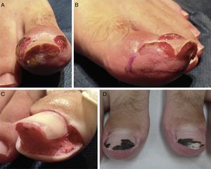 Patient 3. Bilateral stage 3 disease. A, Right great toe. B, Left great toe: A dermographic marker is used to outline the tissue to be excised. C, Intraoperative image after U excision of the periungual granulation tissue. D, Four weeks after surgery, silver nitrate is still visible on the nail plate.