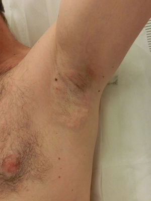 Local inflammation and subcutaneous nodules after treatment.