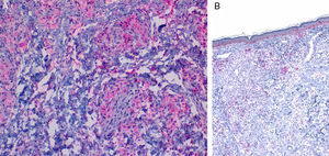 Characteristic immunohistochemical profile of adult xanthogranulomatous disease of the orbit. A, Immunohistochemistry for CD68, ×20. B, Immunohistochemistry for S100, ×4. Expression of CD68 in the histiocytic infiltrate (A) with negative expression of S100. S100 is expressed in epidermal melanocytes and in some isolated cells in the dermis.