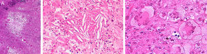 Histopathology of necrobiotic xanthogranuloma. A, Granulomatous inflammatory infiltrate composed of histiocytes and accompanying inflammatory cells (hematoxylin-eosin [HE], ×4). B, Collagen degeneration is visible (HE, ×20). C, Abundant Touton-type multinucleated giant cells with nuclei in rosette formation in the center and vacuolated cytoplasm at the periphery (HE, ×20).