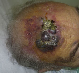 Reddish-violaceous plaque with nodular areas on the forehead of an elderly male.
