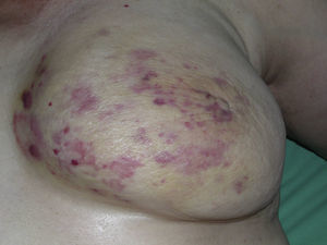 Multiple macules and erythematous patches with several reddish papules on yellowish skin on a breast irradiated due to cancer.