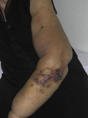 Reddish-violaceous papules and nodules with bruise-like areas on an arm with lymphedema secondary to breast cancer surgery.