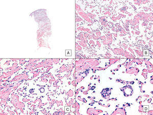 Angiosarcoma with a predominant vasoformative pattern. A, Panoramic image showing infiltration of dermis down to the hypodermis (hematoxylin-eosin, original magnification ×10). B, Neoplastic vascular spaces with pronounced collagen dissection (hematoxylin-eosin, original magnification ×100). C and D, Non-neoplastic vessels dissected by neoplastic endothelial cells, which remain “floating” in the dermis (promontory sign) (hematoxylin-eosin, original magnification ×200 and ×400, respectively).