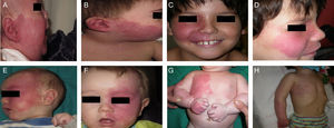 Before and after 7 sessions with laser therapy and difference in response according to site; A, B, C, D, Mandibular area and intense pink color in malar area, difficult to treat; E and F, frontal area and lateral area of face with better response than the central area; G, H, Area of limbs and trunk, worse response in acral areas. Note the good clearance in the pectoral area and arm.