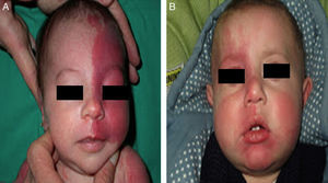 A, Port wine stain with extensive involvement; B, Port wine stain with bilateral involvement.