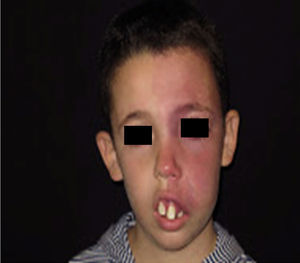 Maxillary and mandibular growth.