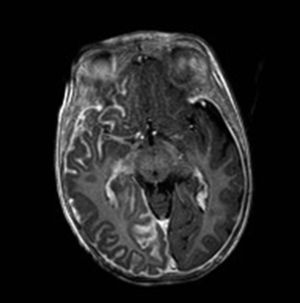 Cranial T1 magnetic resonance imaging, with gadolinium enhancement. Axial plane at the level of the mesencephalon, showing leptomeningeal thickening and uptake typical of leptomeningeal angiomatosis in a patient with SWS.