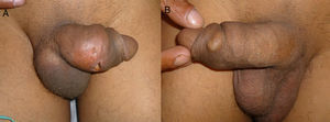 A, Mass of stony consistency, with ulcer with fibrinous base, on the right lateral aspect of the penis. B, Hard subcutaneous nodule, mobile, and with smooth edges, not adhered to the deep planes.
