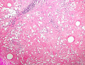 Swiss-cheese image. Diffuse sclerosis of the reticular dermis and subcutaneous tissue with empty pseudocysts.
