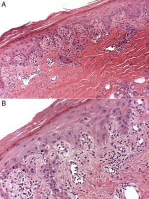 Histology of the lesion on the dorsum of the hand of patient2. A, Hyperkeratotic epidermis with parakeratosis, foci of vacuolar degeneration of the basal layer, and a band-like perivascular infiltrate with occasional eosinophils. Hematoxylin and eosin, original magnification ×10. B, At higher power, evidence of necrotic keratinocytes in the epidermis. Hematoxylin and eosin, original magnification×40.