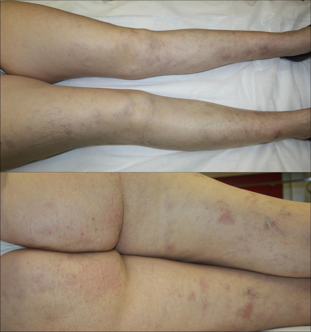 Azathioprine-Induced Hypersensitivity Reaction Presenting as Erythema ...