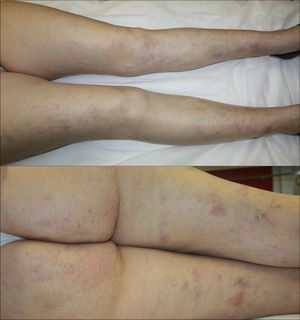 Subcutaneous nodules with superficial erythema and erythematous-violaceous macules of residual appearance on the anterior and posterior aspects of both lower limbs.