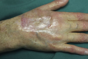 Healing of the ulcer 2 months after closure of the arteriovenous fistula.