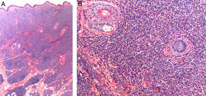 A, Hematoxylin-eosin, original magnification ×40. B, Hematoxylin-eosin, original magnification ×100.