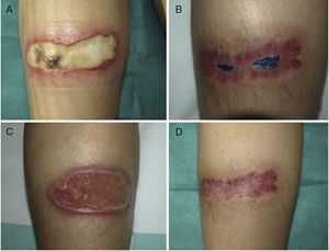 Course of an ulcer on the leg of patient 2. Fusarium oxysporum (and Corynebacterium ulcerans) were repeatedly isolated from the lesion. Images A and C correspond to the beginning of the process and images B and D to after treatment, with the lesions resolving.