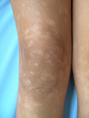 Patient #10. Hypopigmented macules.