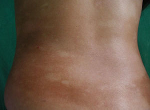 Patient #5. Hypopigmented macules.