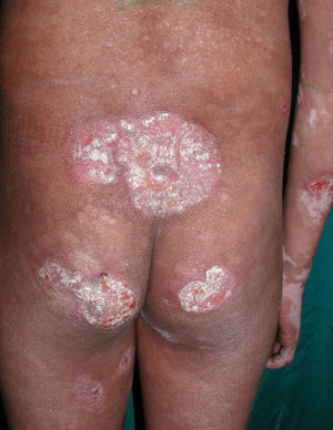 Patient #1. Achromic macules, plaques, and ulcerated tumor.