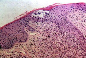 Epidermotropic atypical lymphocytes and Pautrier microabscess (hematoxylin-eosin, original magnification ×20).